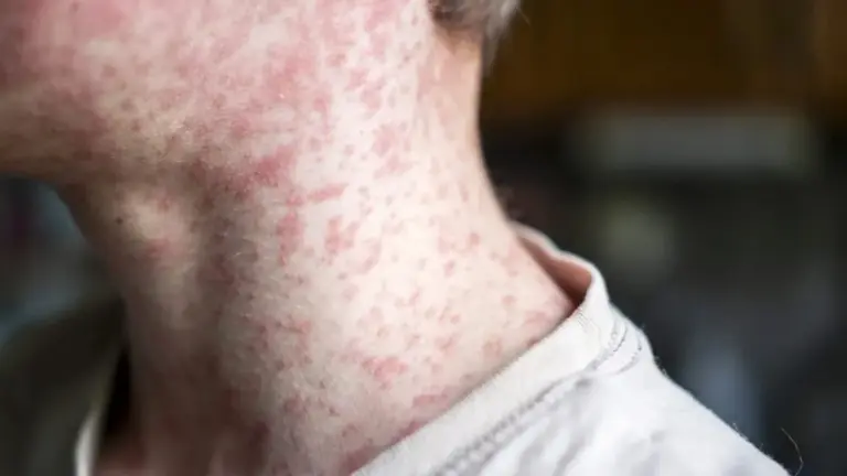 Resurgent Threat: Pennsylvania Confirms Fourth Measles Fatality as Historic Outbreak Surges Past 690 Cases